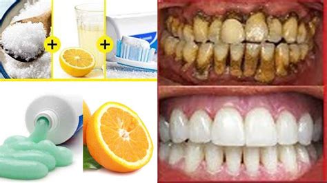 salt spray dental cleaning|salt brushing toothpaste.